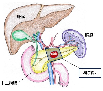 図5_膵中央切除の範囲