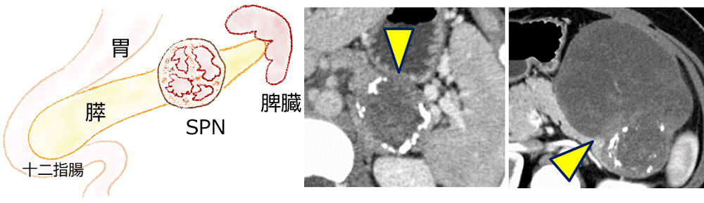 図4_充実性偽乳頭状腫瘍(SPN)