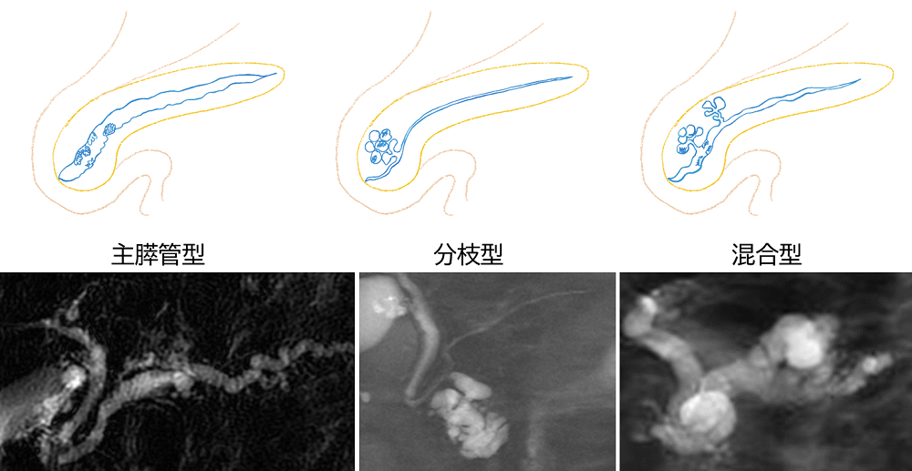 図1_膵管内乳頭粘液性腫瘍(IPMN)