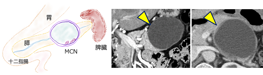 図3_粘液性嚢胞腫瘍(MCN)