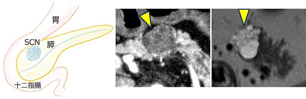 図5_漿液性嚢胞腫瘍(SCN)