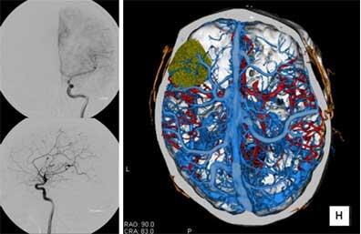 脳血管撮影（左）とCT血管撮影（右）