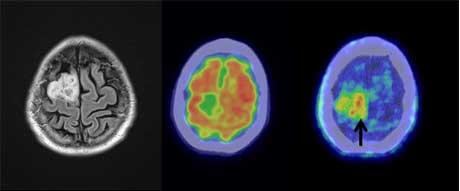 脳腫瘍と脳梗塞の鑑別