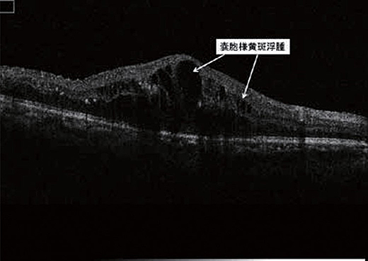 抗悪性腫瘍薬による網膜浮腫image 抗悪性腫瘍薬による網膜浮腫image