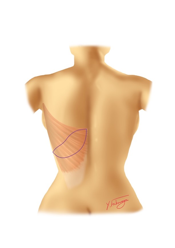 広背筋皮弁図2