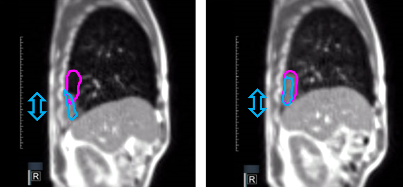 Lung Tumor