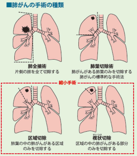 肺がんの手術の種類