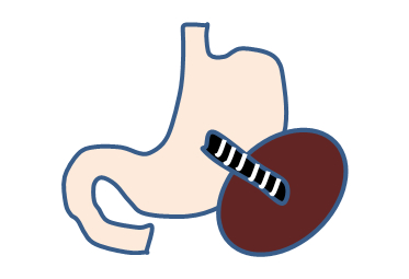 EUS-cyst drainage略図