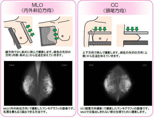 マンモグラフィー 