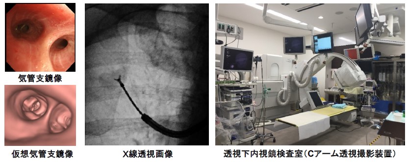 透視下気管支鏡の画像