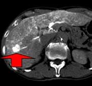 肝動脈造影CTで腫瘍位置と栄養血管を確認（矢印：肝細胞癌）