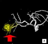 肝臓動脈と肝腫瘍の3次元画像