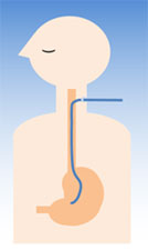 食道に口を作り、胃や腸まで
