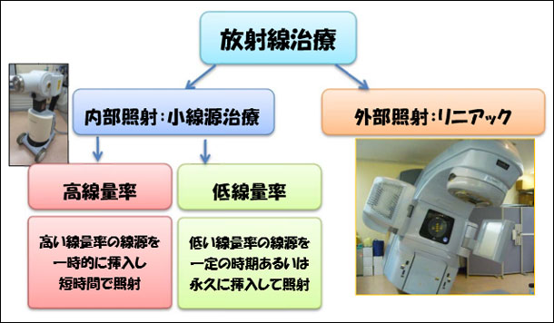 高線量率密封小線源治療 国立がん研究センター 中央病院