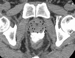 a.前立腺にアプリケータを配置して撮影したCT画像