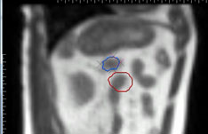 照射位置(赤)から病巣(青)が外れており、放射線が照射されない
