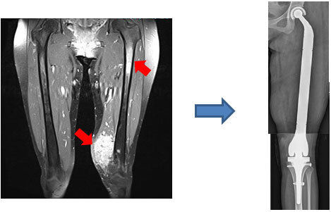大腿部胞巣状軟部肉腫で大腿骨にも転移を認めた症例画像