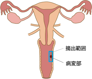 図3_部分腟壁切除術の摘出範囲