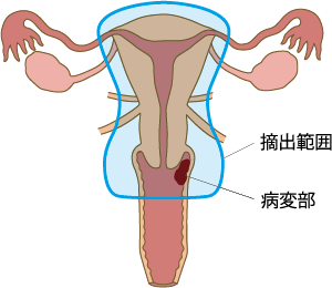 図4_広汎子宮全摘出術＋腟部分切除術の摘出範囲