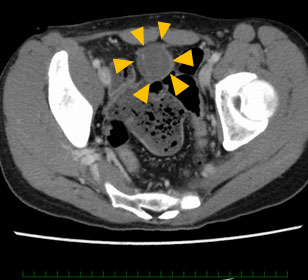 画像　矢頭：CT画像上の尿膜管がんの腫瘤（骨盤内）