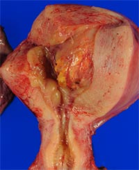 子宮内膜間質肉腫画像