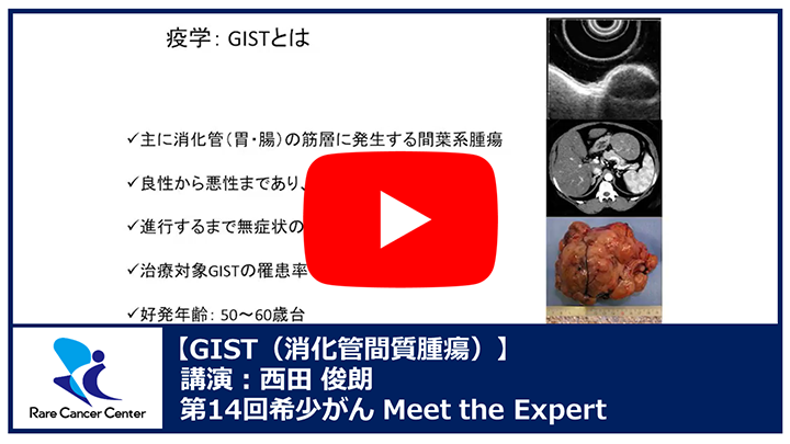 第14回GIST（消化管間質腫瘍）講演：西田 俊朗