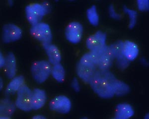 NUT融合遺伝子陽性がんにおけるNUT遺伝子の再構成(FISH法)