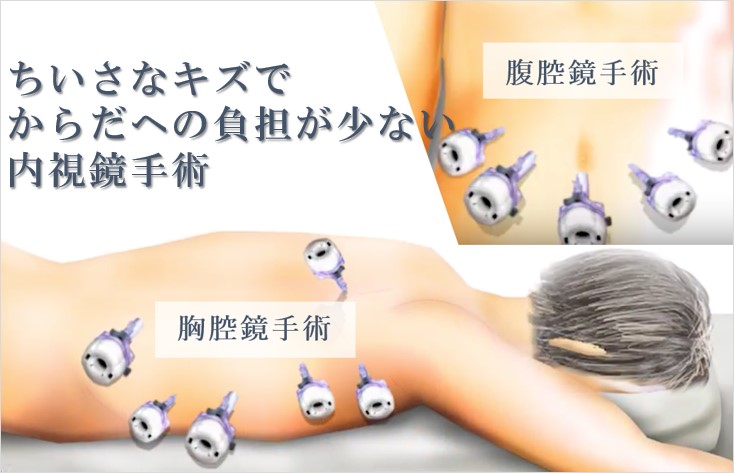 からだへの負担が少ないがん手術のイメージ