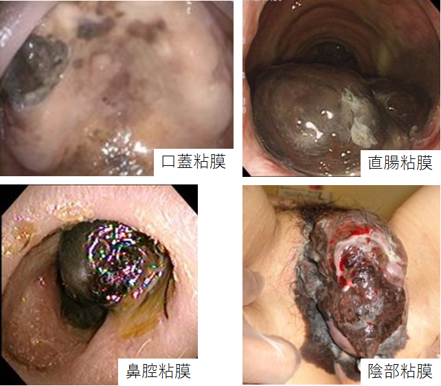 粘膜・眼部の悪性黒色腫図2