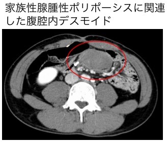 デスモイド腫瘍 希少がんセンター