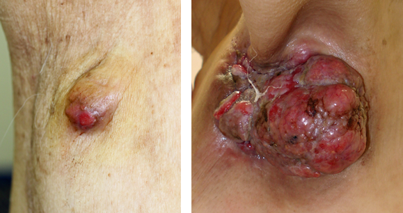 図7皮膚付属器癌