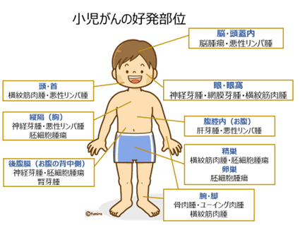 小児の固形悪性腫瘍 希少がんセンター