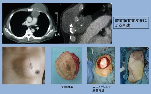 体幹の肉腫 希少がんセンター