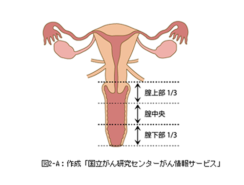 外陰 癌 しこり 画像