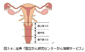 画像 しこり 外陰 癌