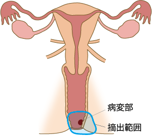 図5_広汎外陰切除術＋腟部分切除術の摘出範囲