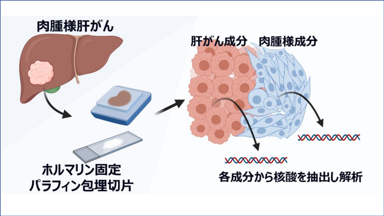 肉腫様肝がん