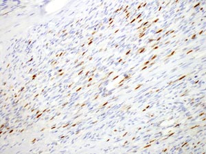 紡錘形細胞型横紋筋肉腫におけるmyogenin免疫染色陽性所見