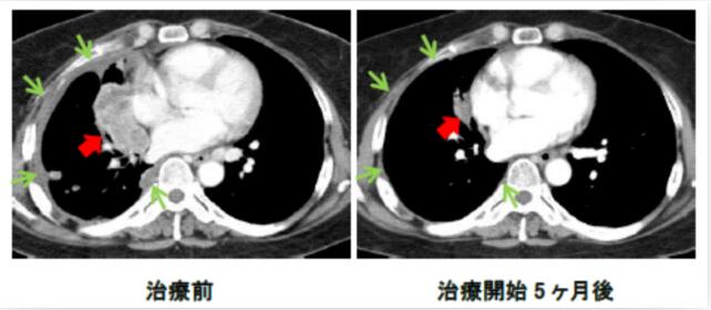 分子標的治療薬が新しい治療法になる可能性