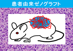 患者由来ゼノグラフト